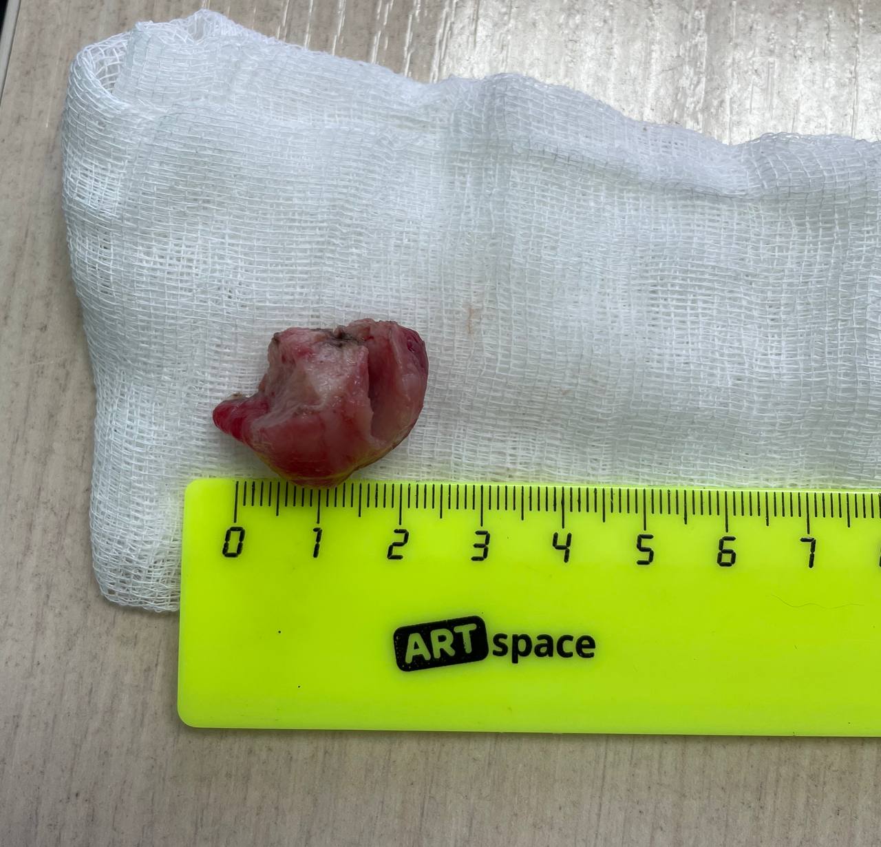 Фото В Улан-Удэ врачи удалили опухоль из трахеи 20-летней девушки