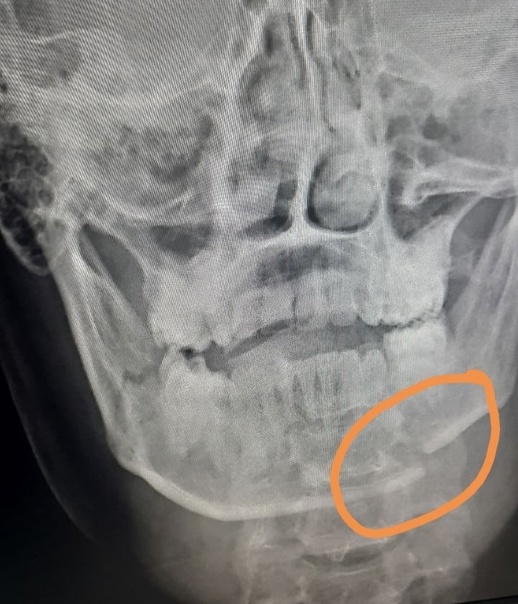 Фото В Бурятии мужчина сломал челюсть, упав с небольшой высоты