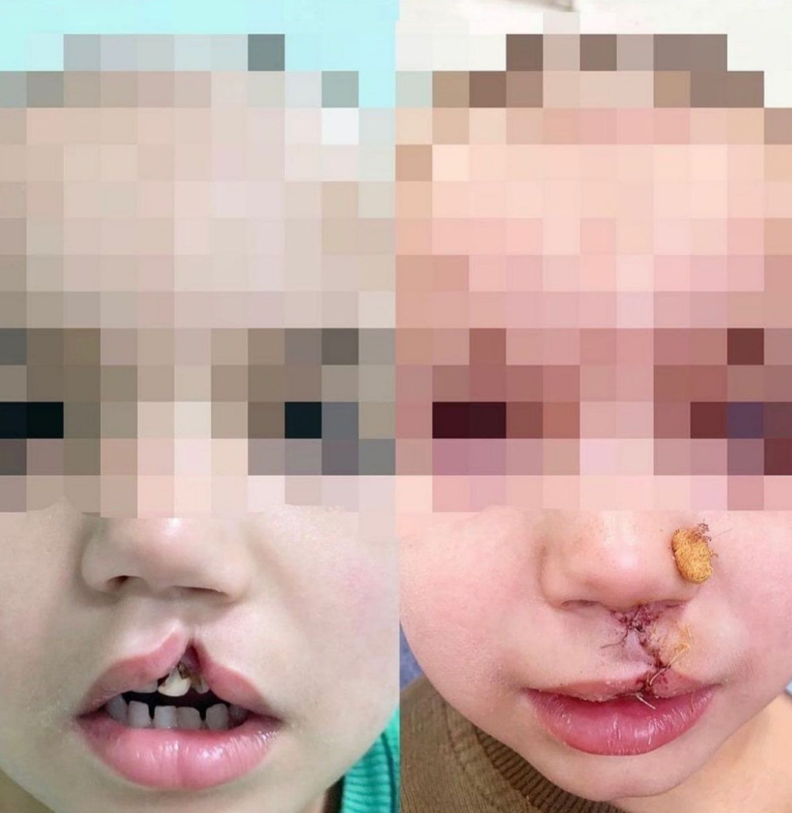Фото В Бурятии прооперировали ребенка с «заячьей губой»