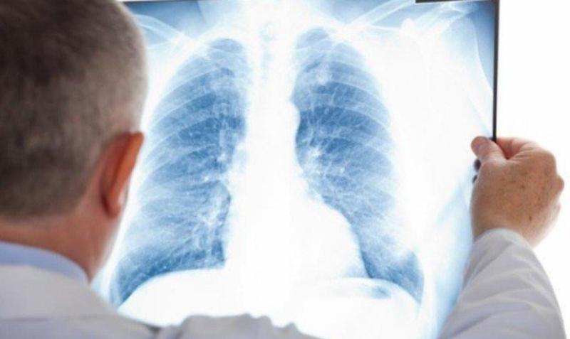 Фото В Бурятии обнаружен самый смертоносный штамм туберкулеза среди известных в России