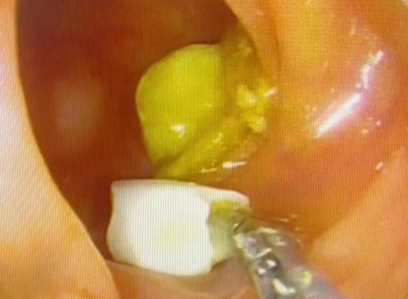 Фото В Бурятии врачи извлекли зуб из кишки пациентки