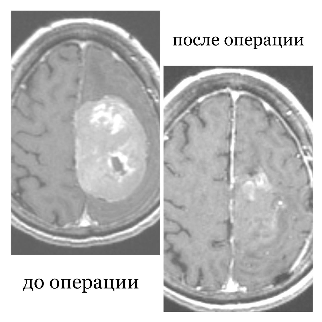 Фото Нейрохирурги Бурятии спасли пациентку с опухолью мозга, которая шесть лет отказывалась от операции