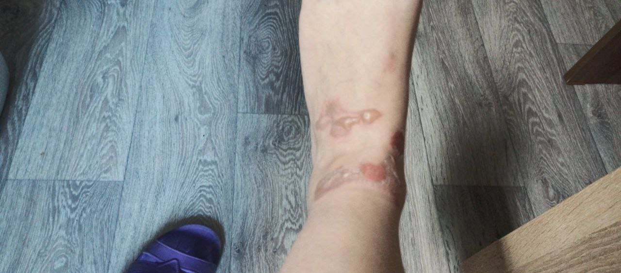 Фото Многодетная мать в Улан-Удэ получила ожоги ног