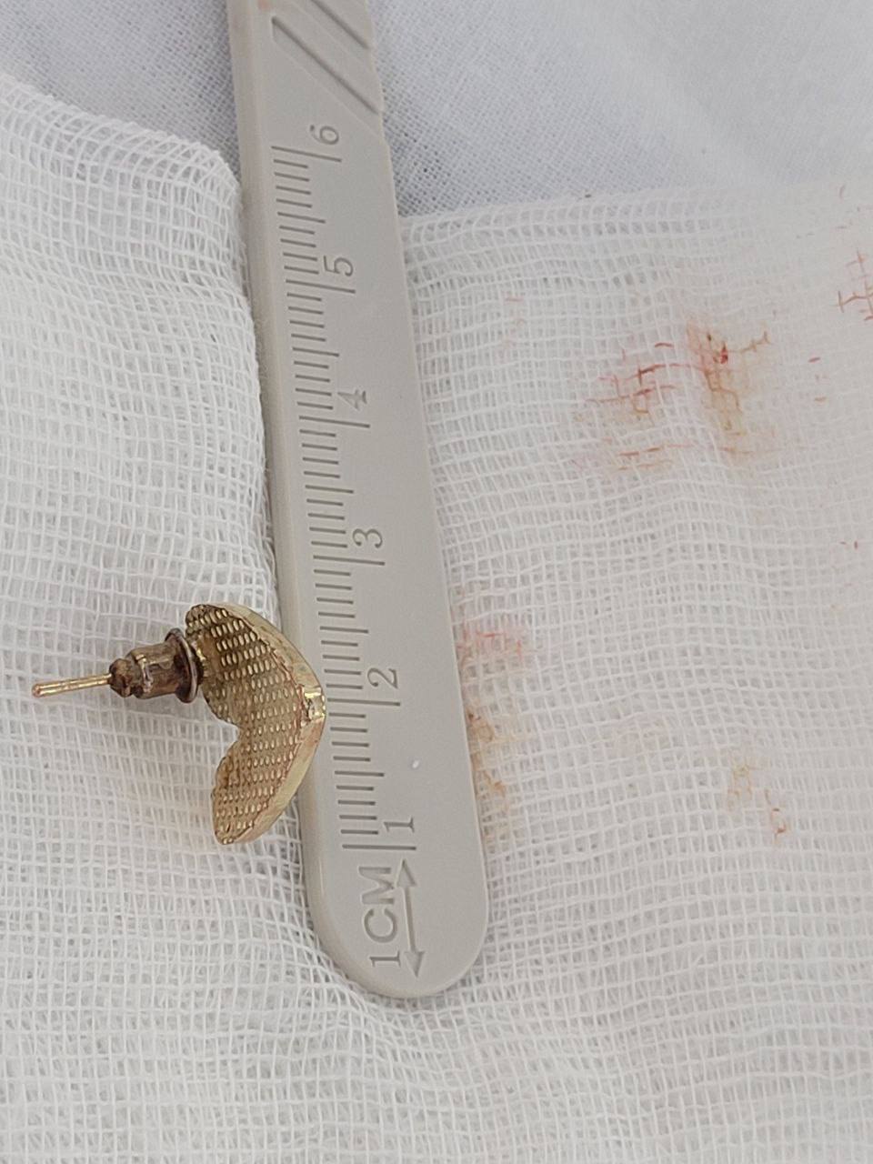 Фото В Бурятии врачи спасли полугодовалого ребенка, проглотившего серёжку 