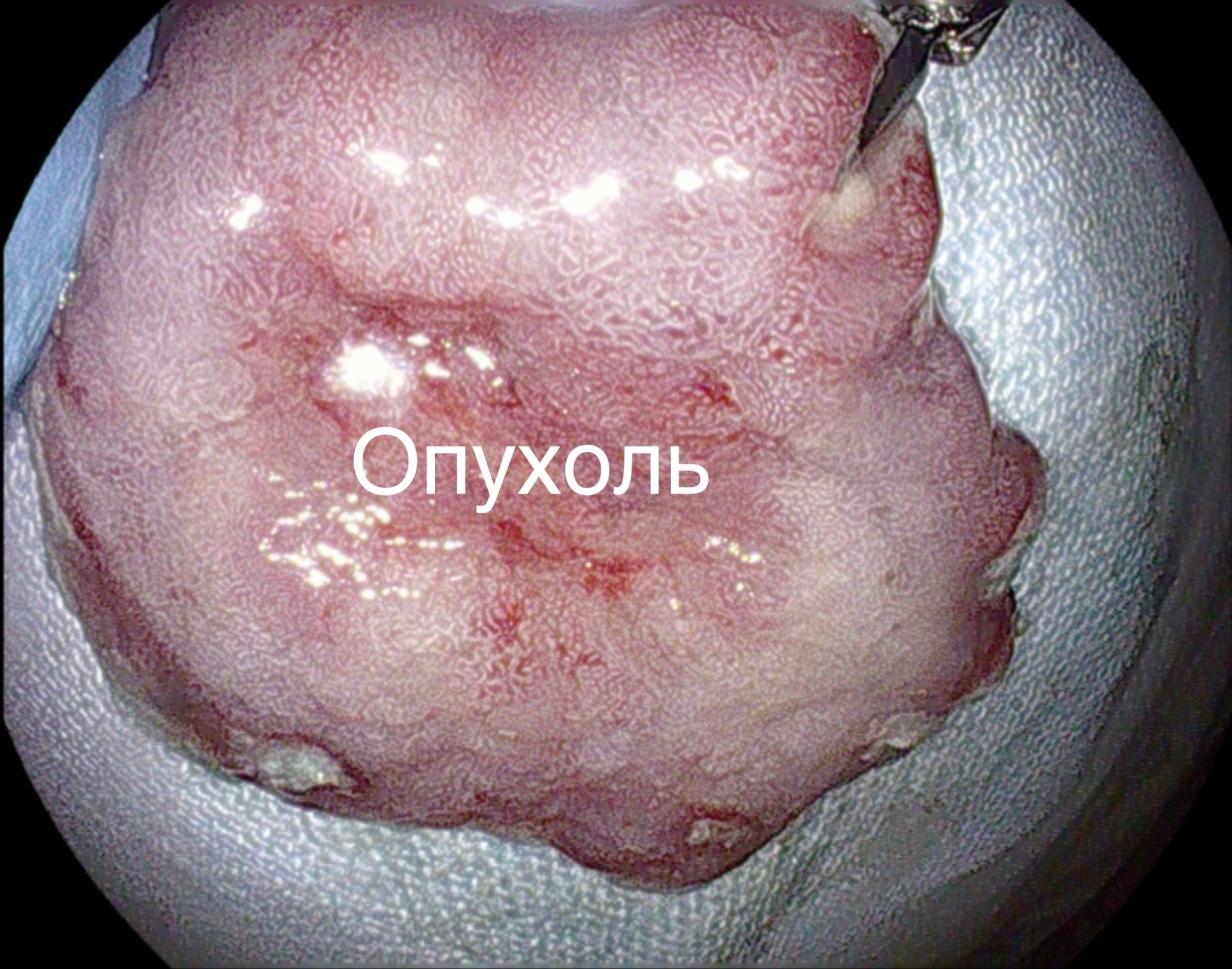 Фото Простое ЭГДС сохранило желудок пациенту из Бурятии