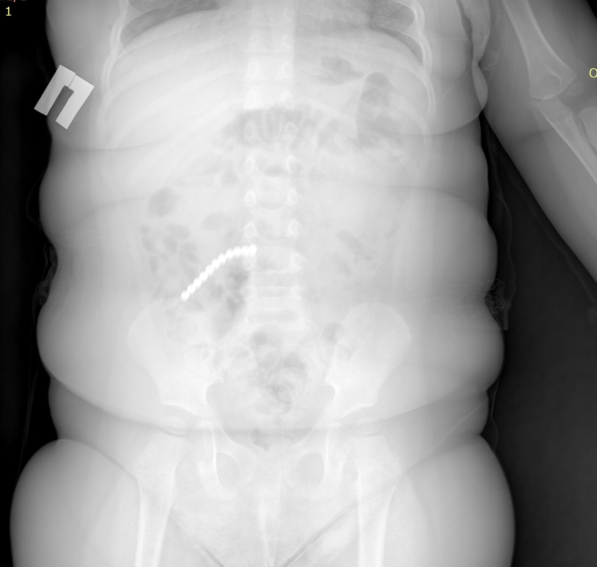 Фото Над спасением маленького глотателя магнитов в Бурятии работала целая бригада врачей 