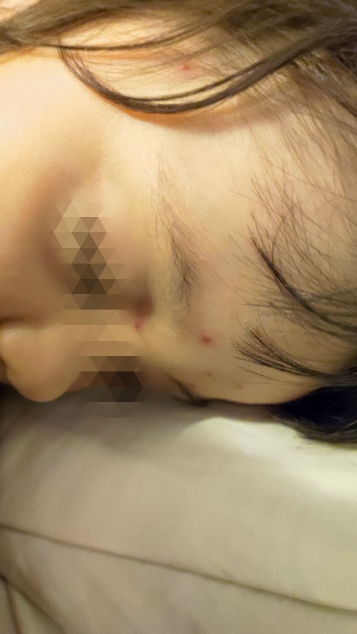 Фото Как жителям Бурятии обезопасить себя от ветряной оспы